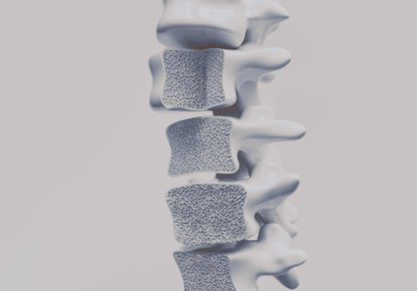 Picture for: Posture Osteoporosis: Building Better Bones