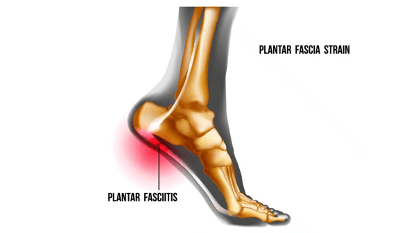 Course Finding Relief from Plantar Fasciitis and Foot Pain - NEW! image 1