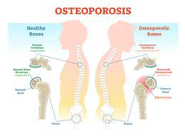 Picture for: POSTURE & OSTEOPOROSIS WORKSHOP: BUILDING BETTER BONES - ONLINE