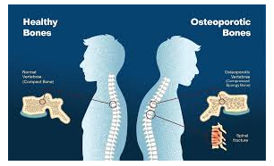 Picture for: Posture & Osteoporosis Workshop: Building Better Bones